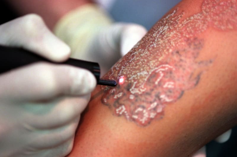 Odstraňování tetování - Obrázek 4