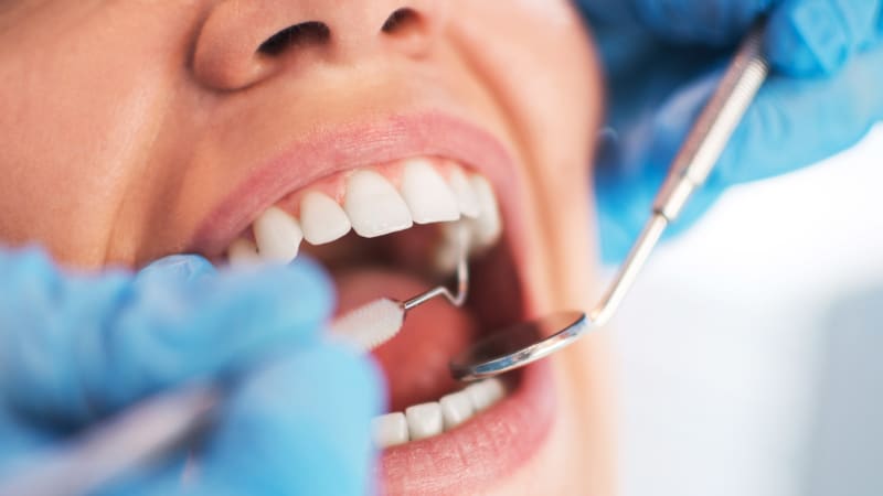 Vyvracíme mýty o zdraví: Parodontóza nebolí, přitom může být velmi nebezpečná
