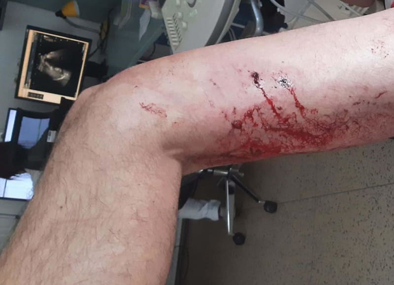 Zranění napadeného muže z Rousínova po útoku psa.