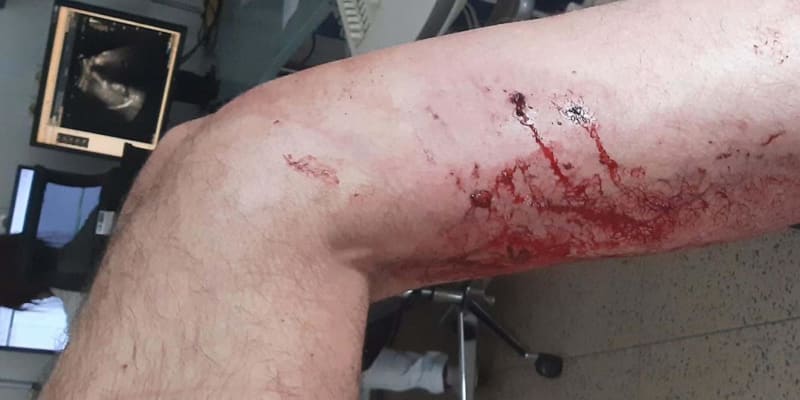 Zranění napadeného muže z Rousínova po útoku psa.