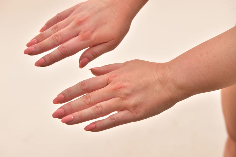 Hřbety rukou omlazené botulotoxinem