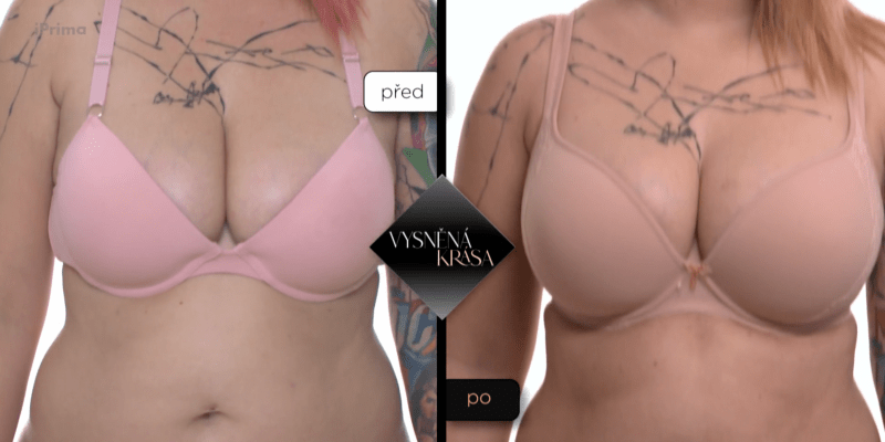 Před úpravou prsů a po ní
