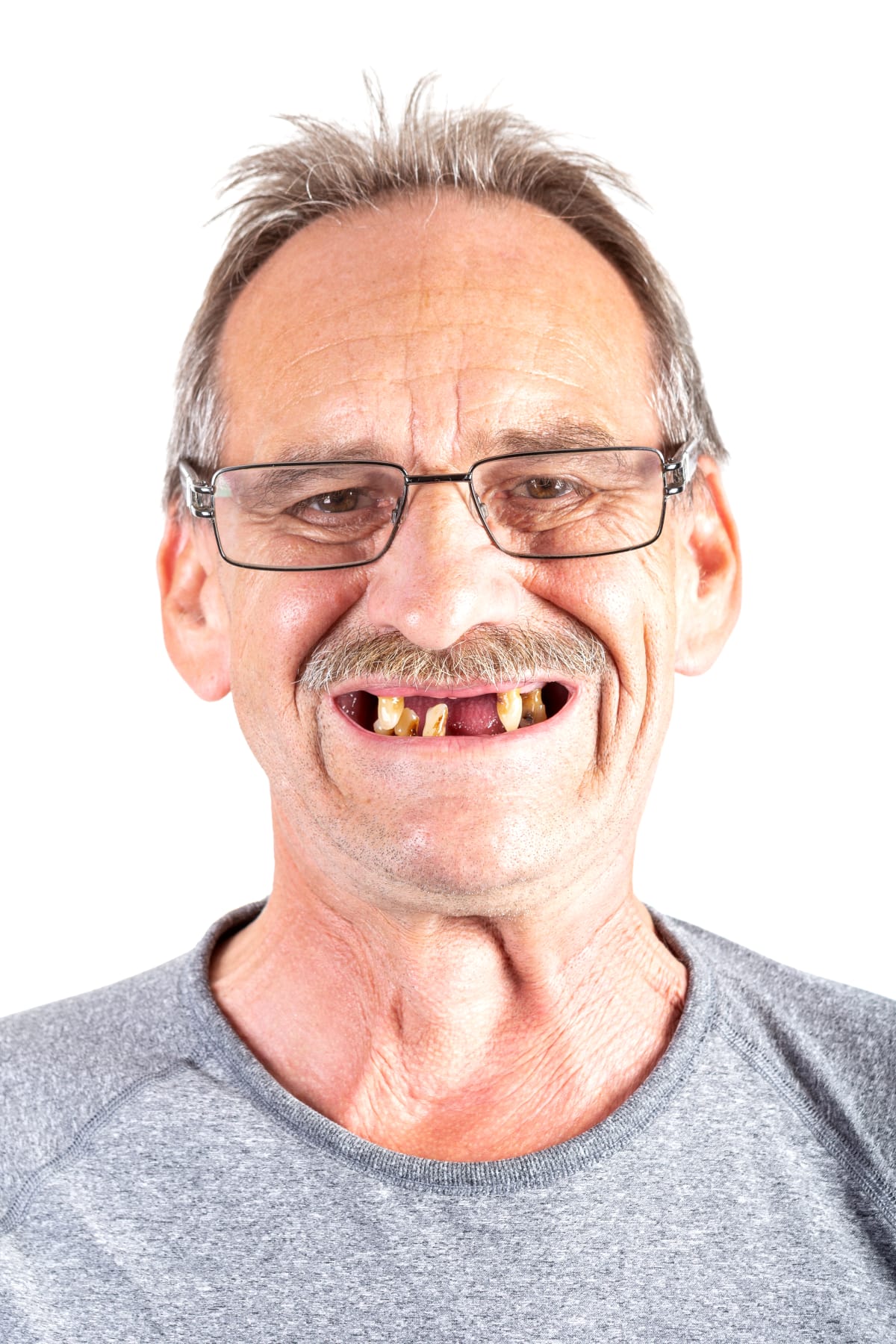 Twenty years with only four teeth