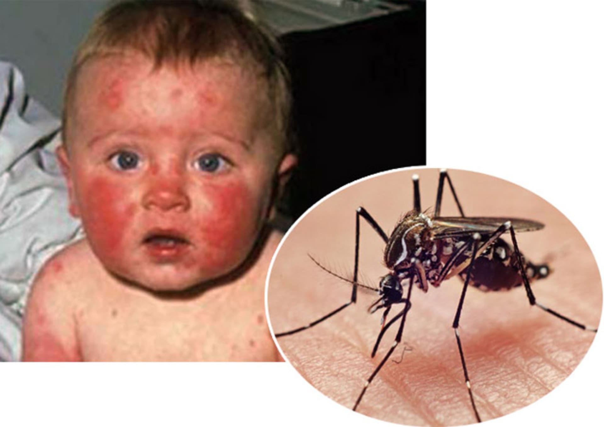 Zastavíme virus zika?