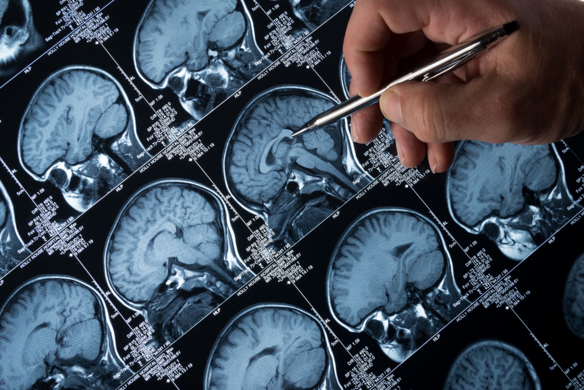 Mozek během nemoci viditelně degeneruje