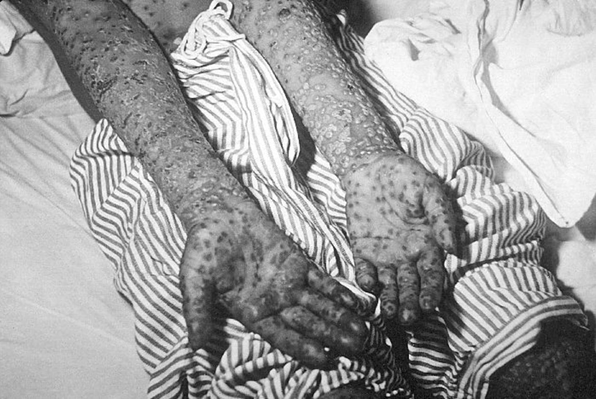 Pacient postižený neštovicemi v Jugoslávii na jaře 1972