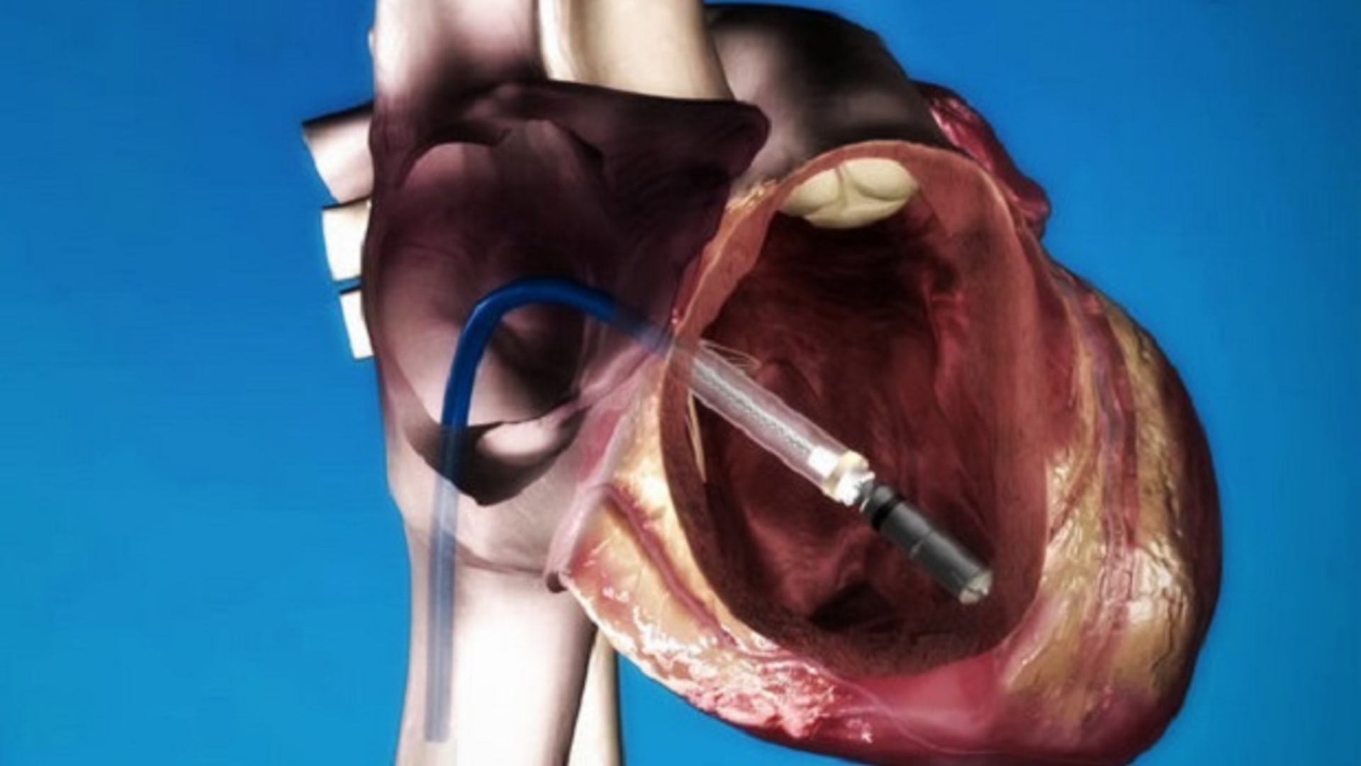 Srdce a kardiostimulátor