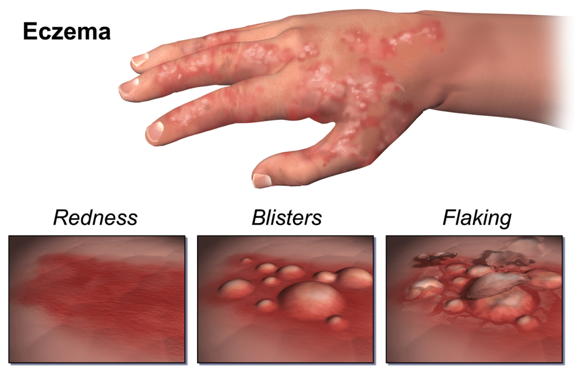 Kožní ekzémy