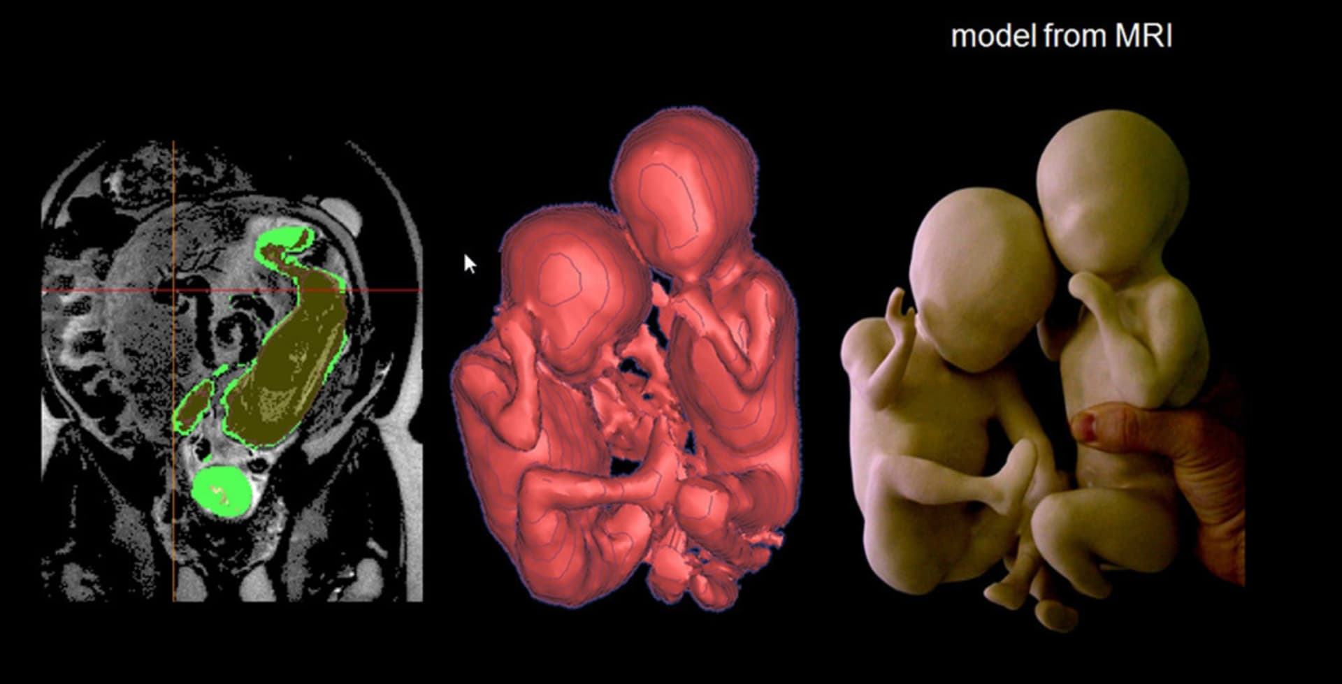 3D sken embrya
