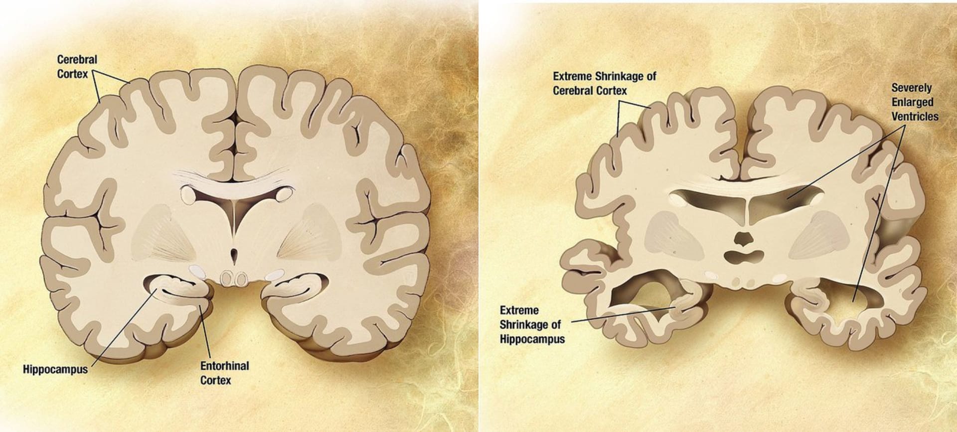 mozek zdravého člověka a jedince postiženého Alzeimerovou chorobou