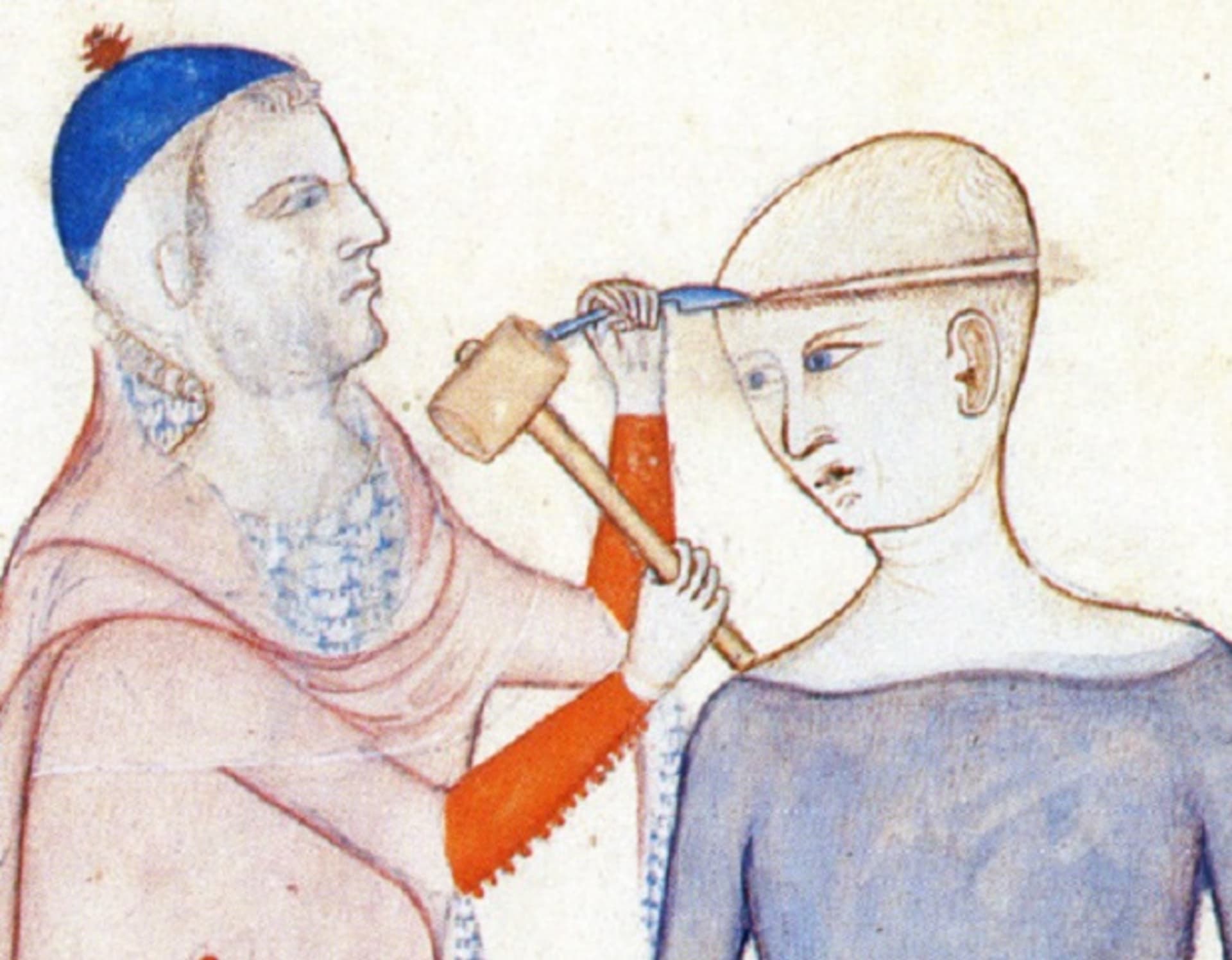 Středověká trepanace lebky