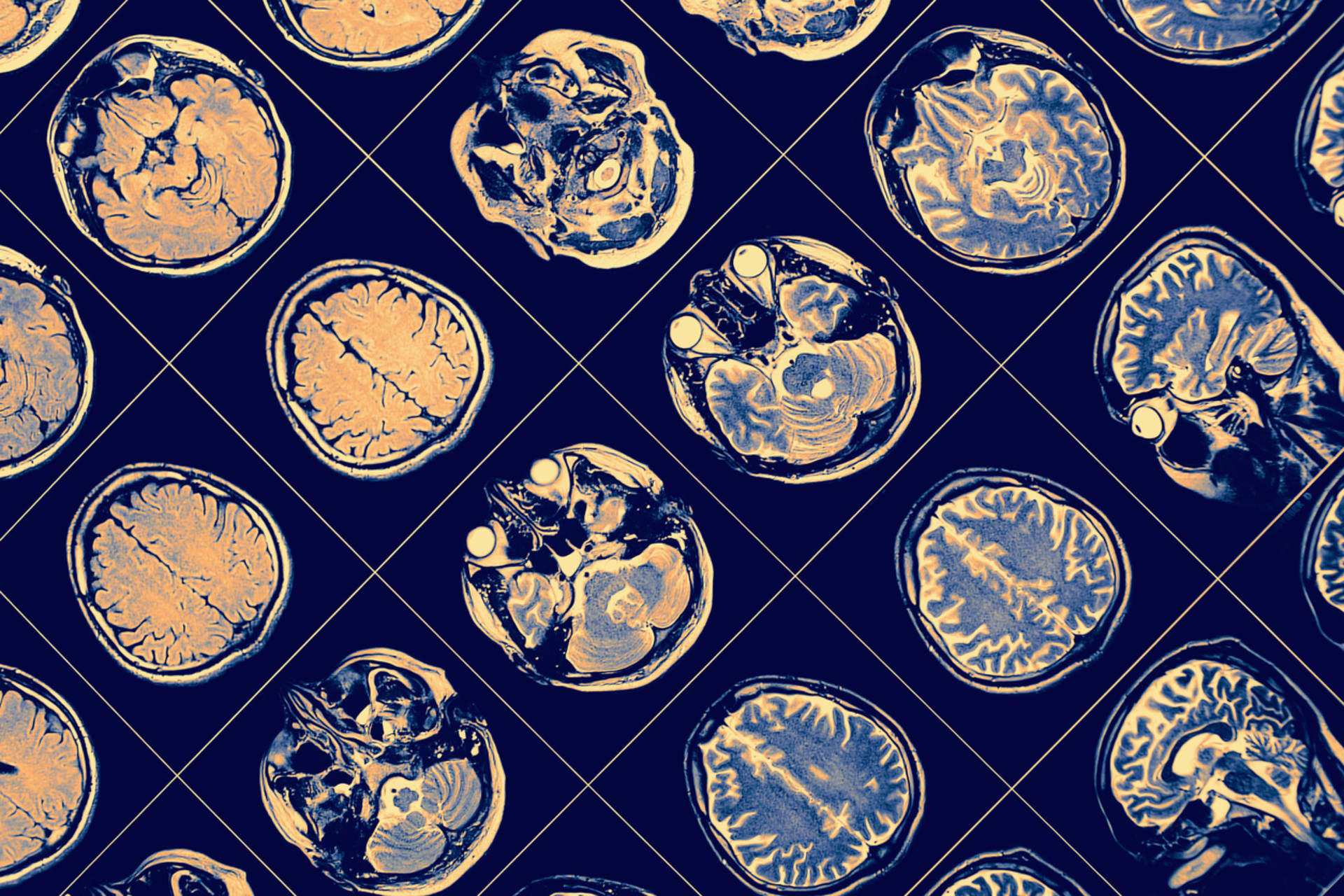 CT mozku může odhalit změny