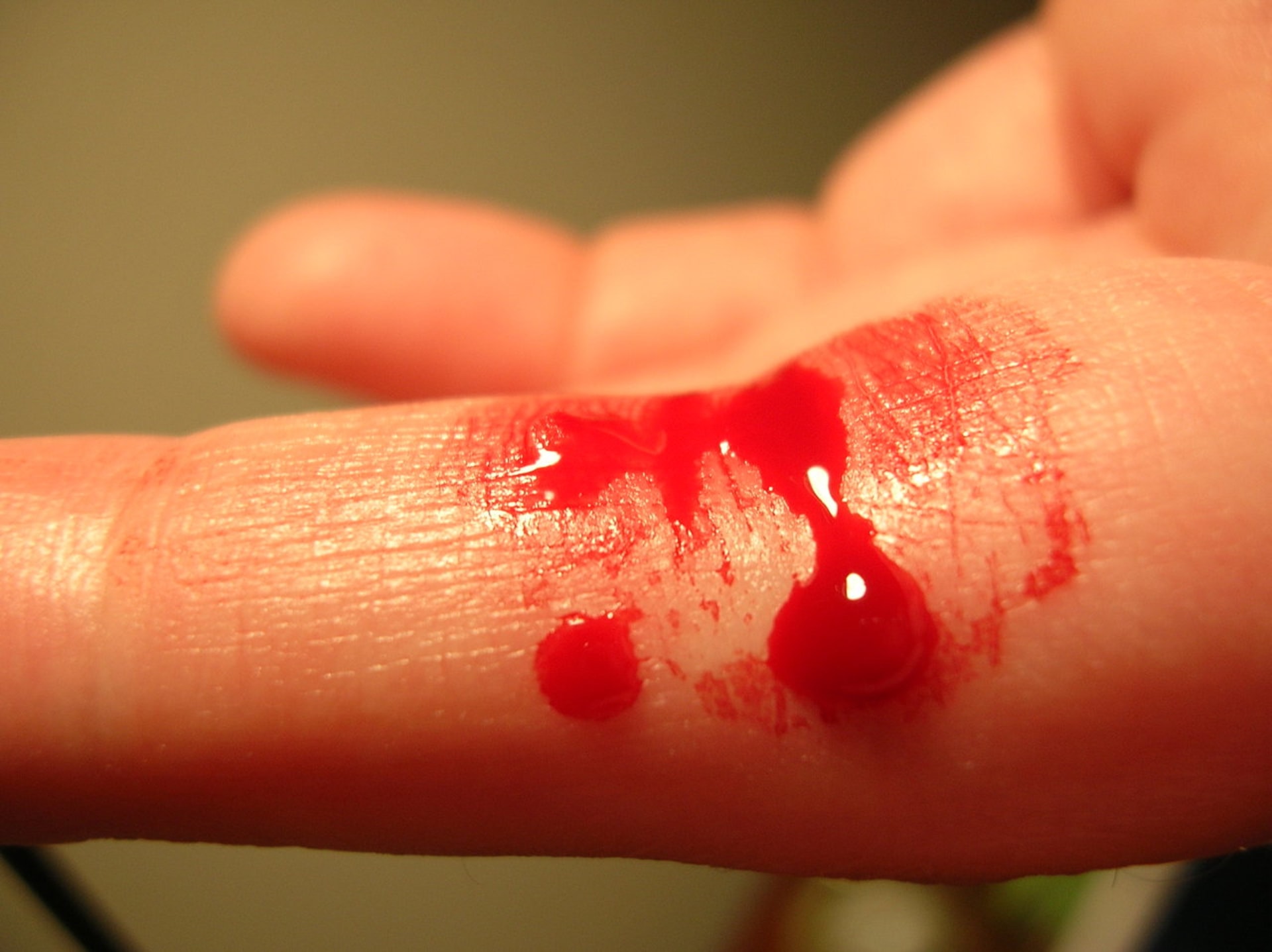 Krvácející prst