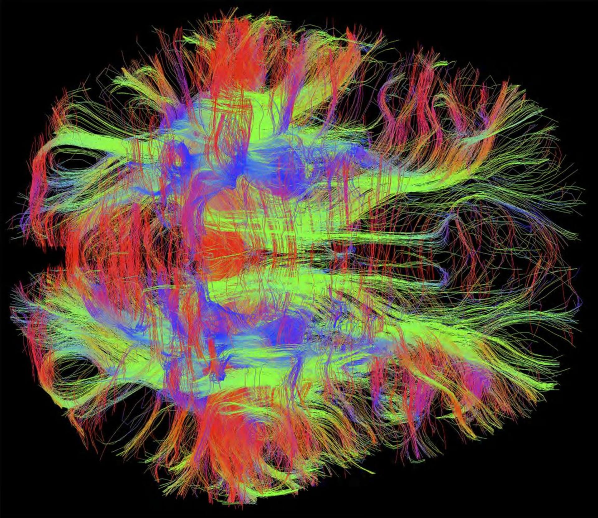 Pohled shora na nervy ve zdravém lidském mozku pomocí technologie DWI MRI