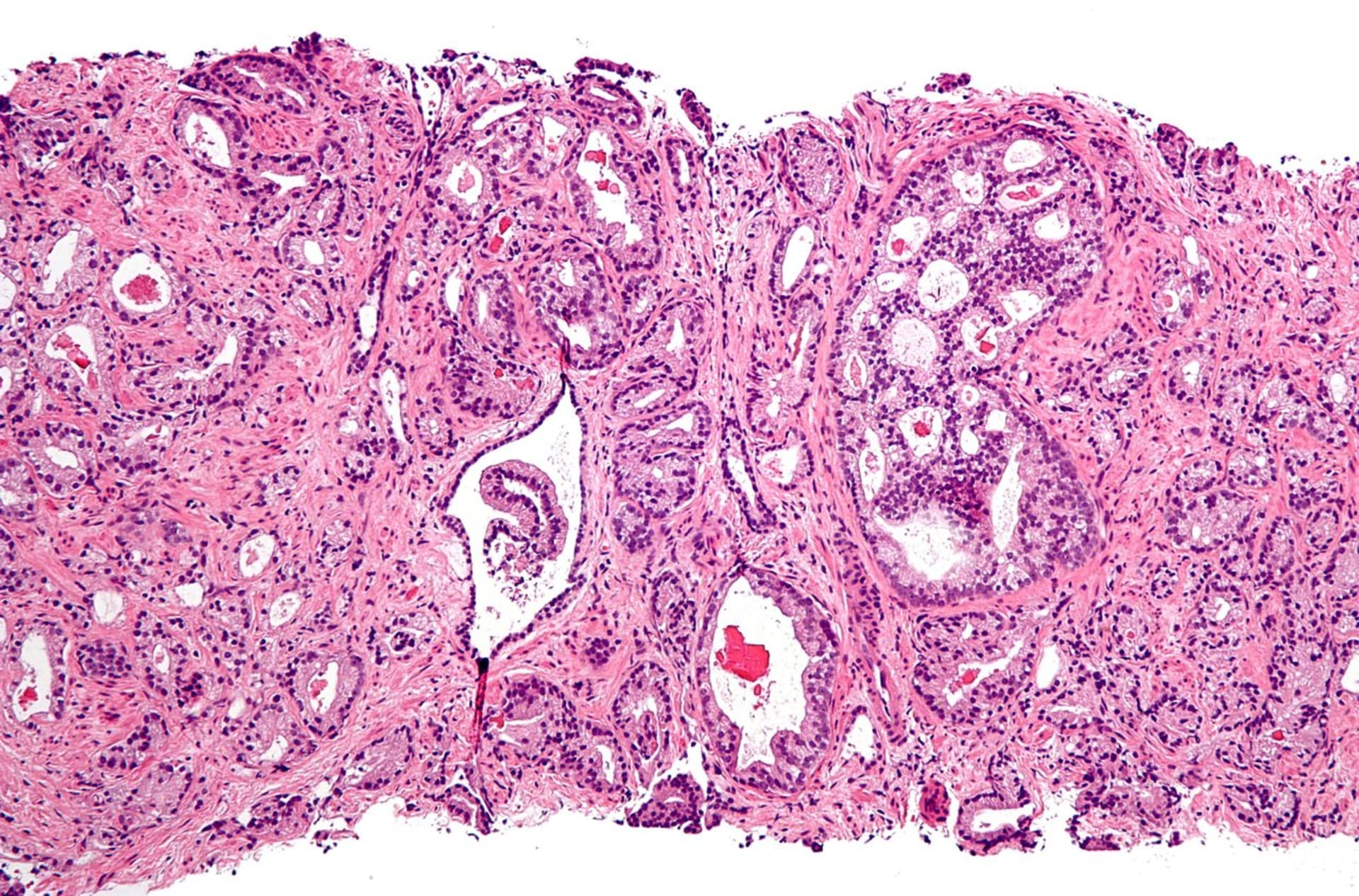 Rakovina prostaty pod mikroskopem