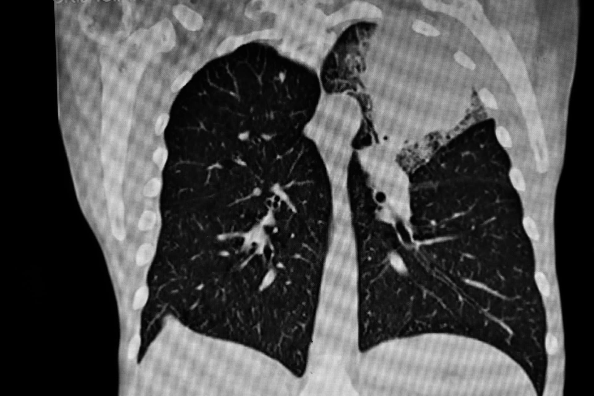 Nádor v plíci na rentgenu