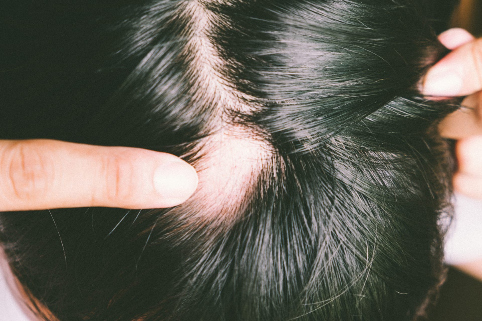 Ohraničená holá místa ve vlasech jsou pro alopecii typická