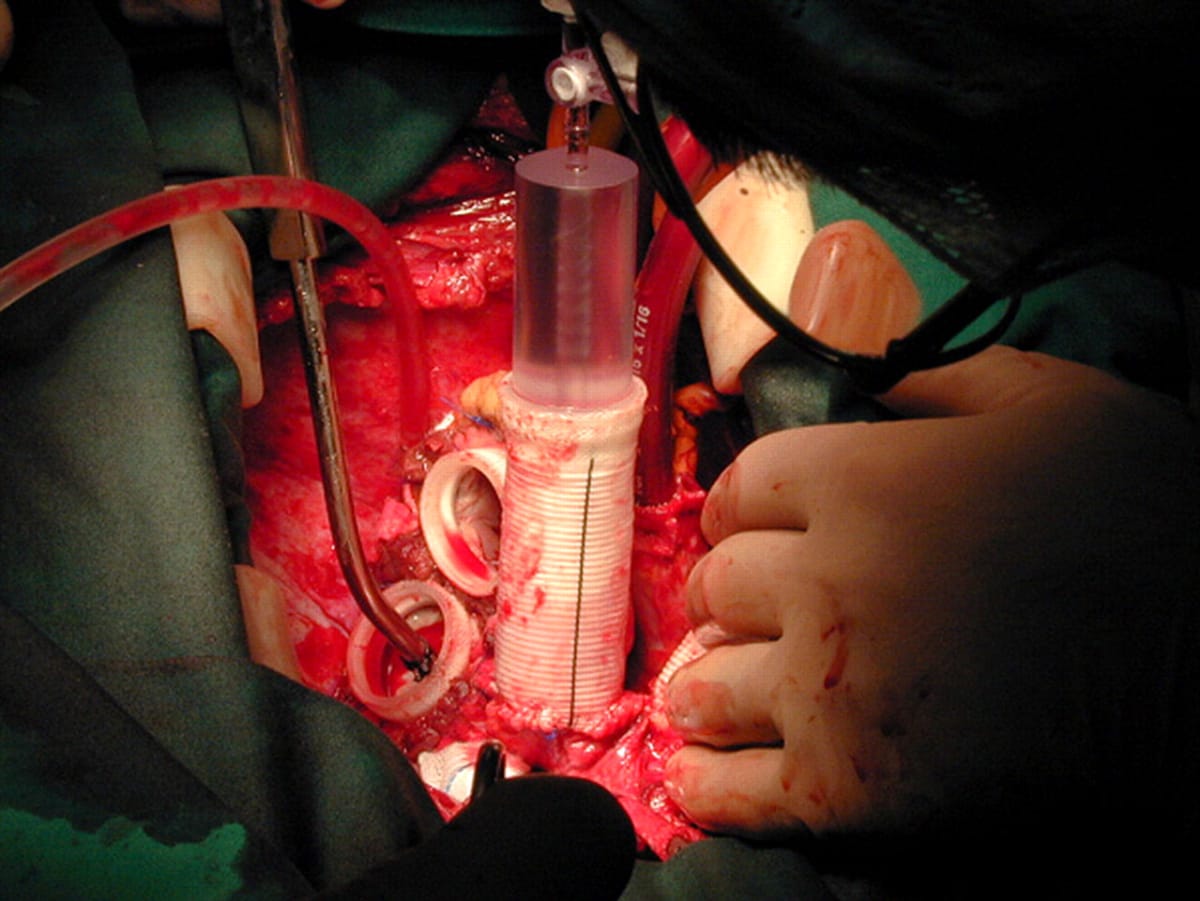 Implantace srdce