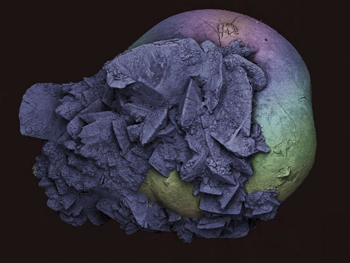 Jde o ledvinový kámen autora snímku; je vyfotografován elektronovým mikroskopem