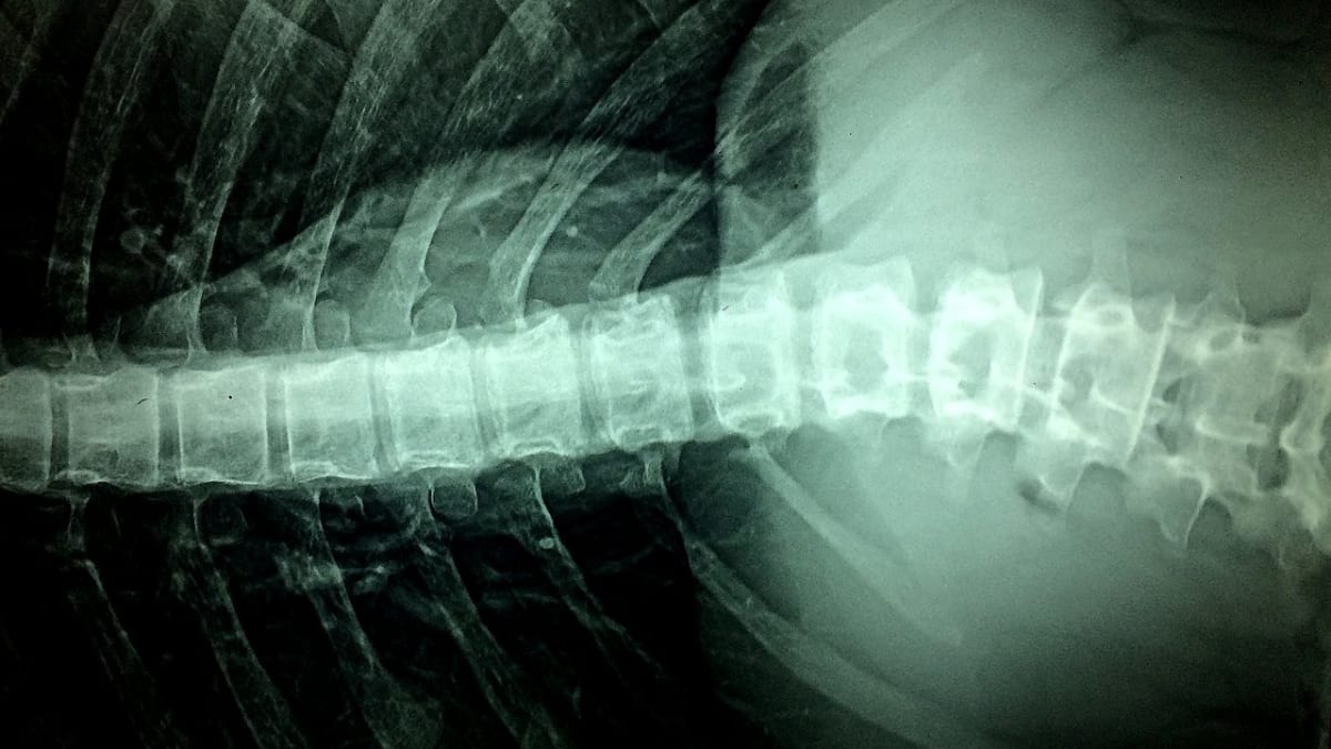 rentgen páteře - její poškození nese ve svých následních nebezpečí ochrnutí
