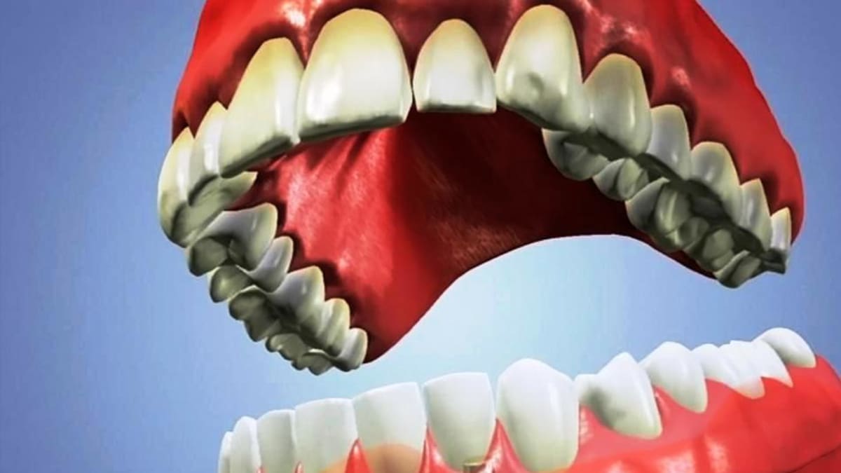 novodobá zubní protéza