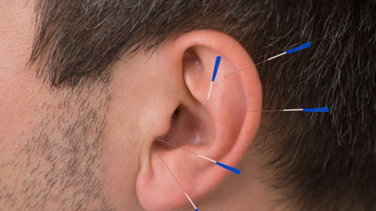 Akupunktura v uchu