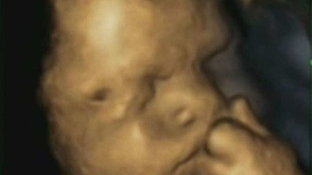 4D sken dítěte v děloze