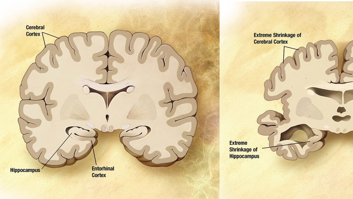 Mozek zdravého a dementního jedince