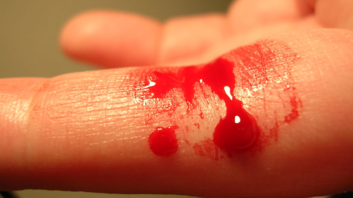 Krvácející prst