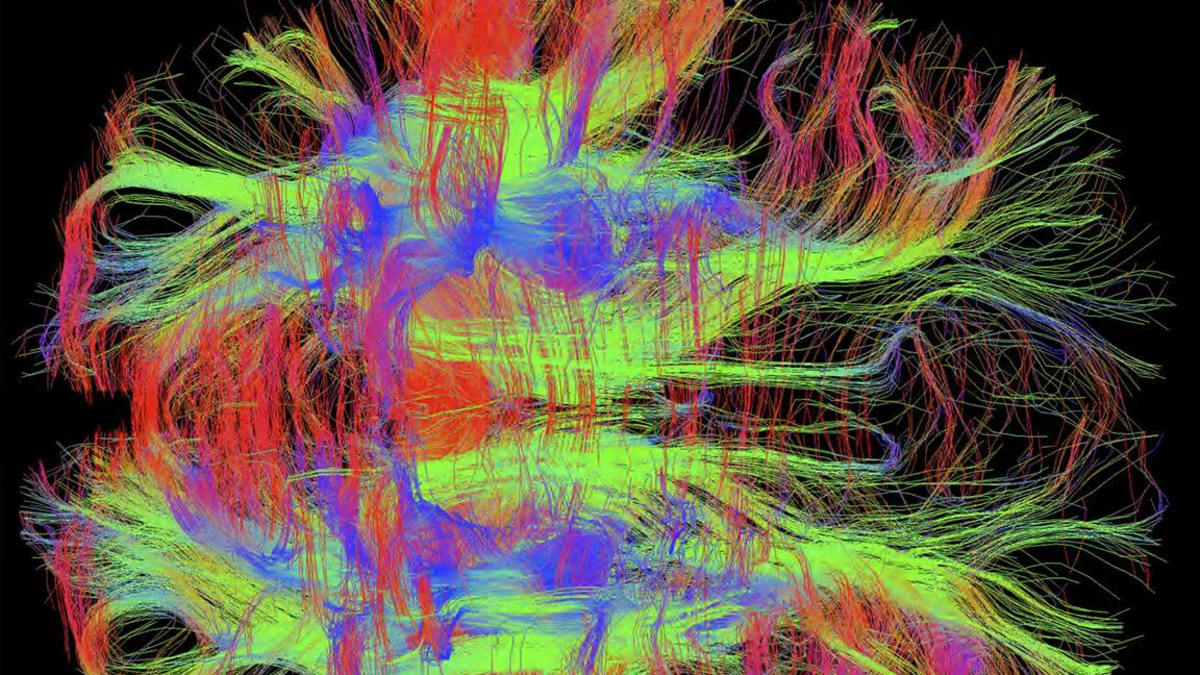 Pohled shora na nervy ve zdravém lidském mozku pomocí technologie DWI MRI