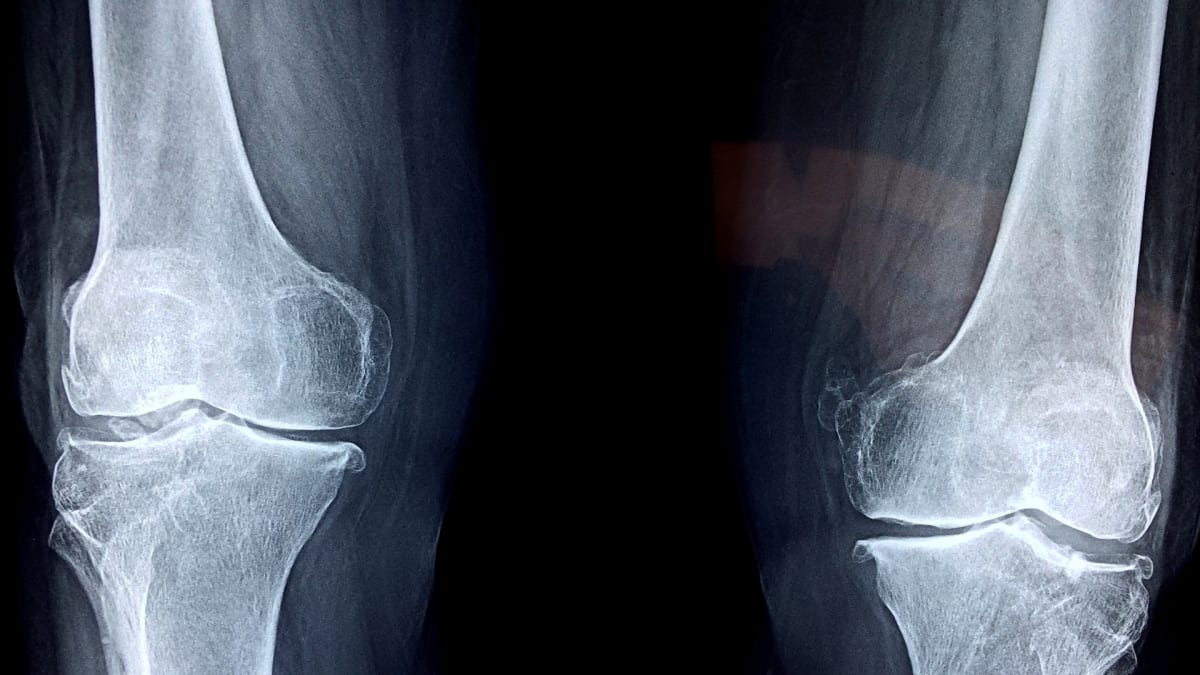 Budoucnost kostních implantátů je v 3D tisku