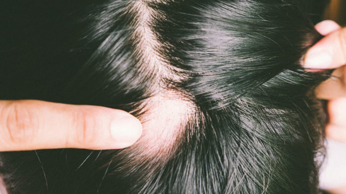 Ohraničená holá místa ve vlasech jsou pro alopecii typická