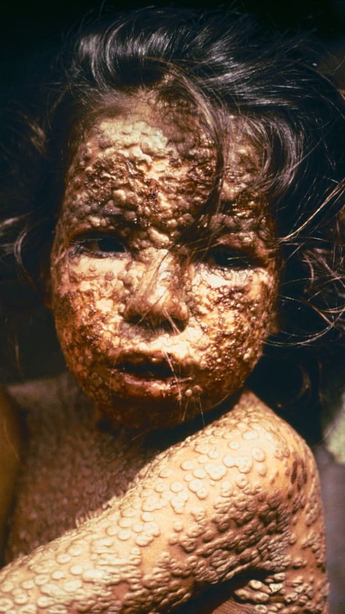 Dítě postižené neštovicemi
