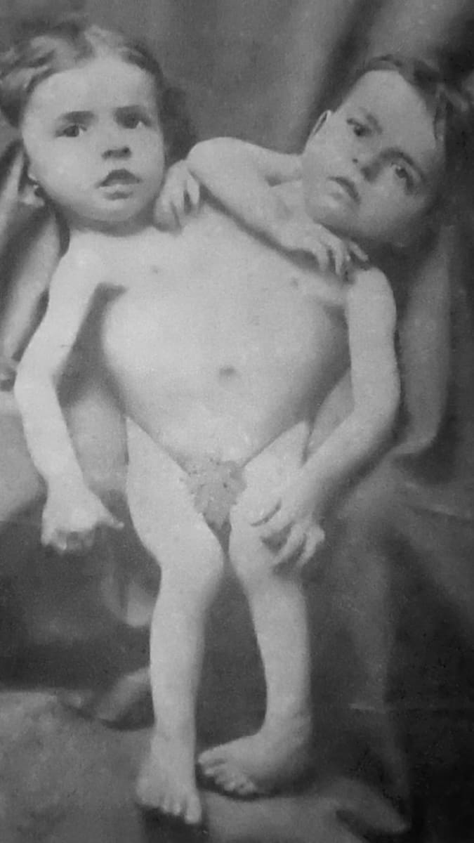 Dvouhlavé dvojče - foto z roku 1881