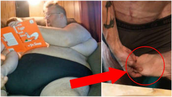 GALERIE: Obézní Američan se skoro užral k smrti! Dnes váží o 150 kilo míň a z nohou mu visí kůže!