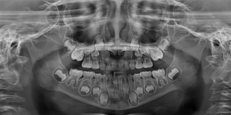 Takto vypadají zuby dítěte ve věku 6–12 let, když jsou mléčné zuby nahrazovány stálým chrupem
