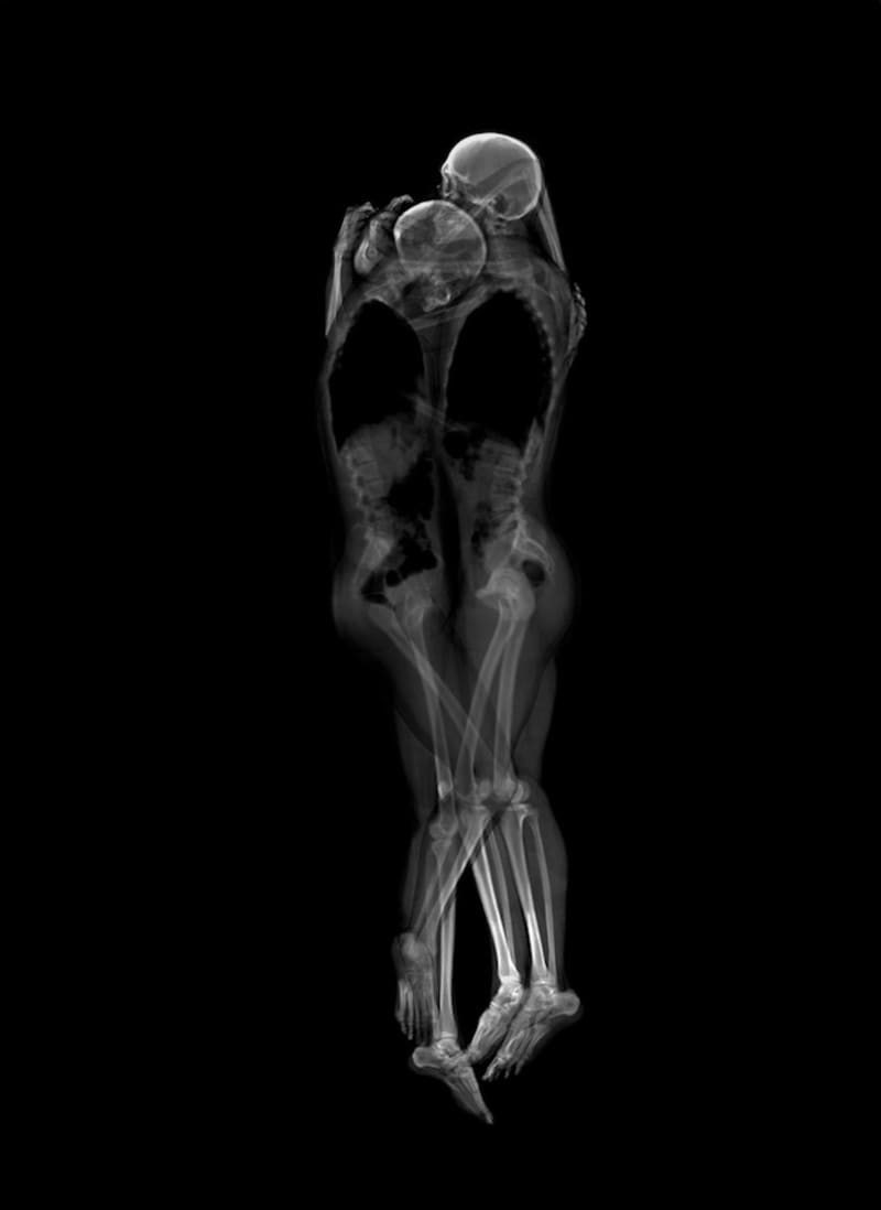 Láska pod rentgenovými paprsky
