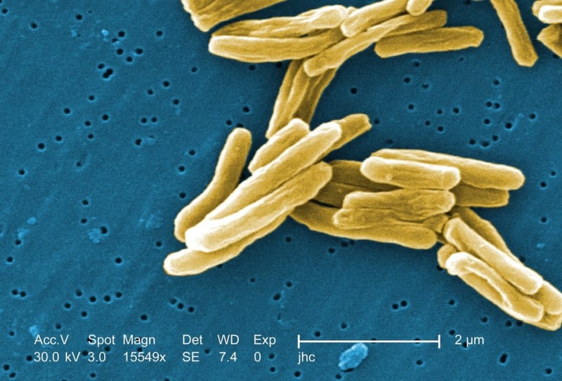 Mycobacterium tuberculosis způsobuje tuberkulózu