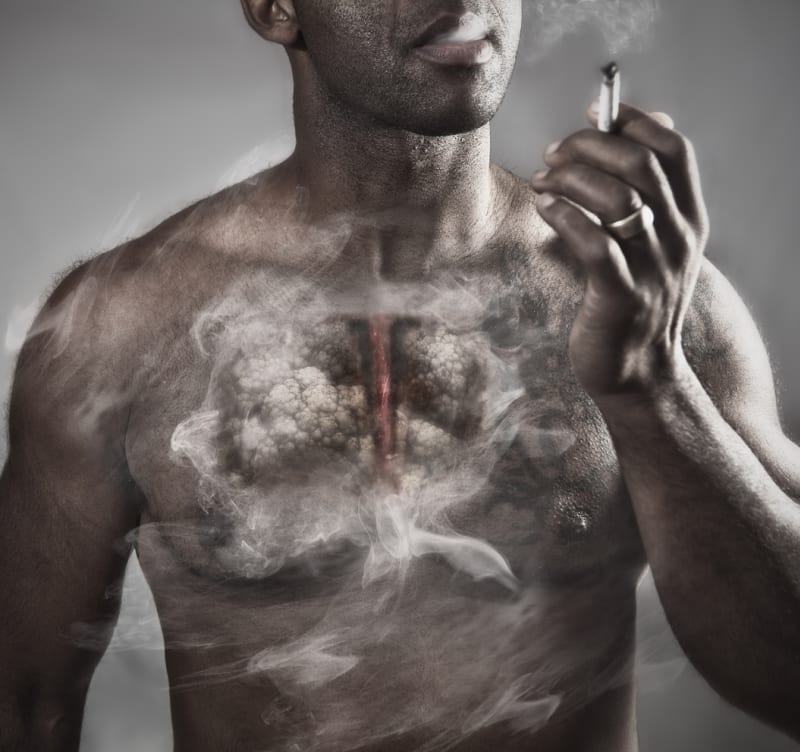 70 procent pacientů s rakovinou plic tvoří kuřáci