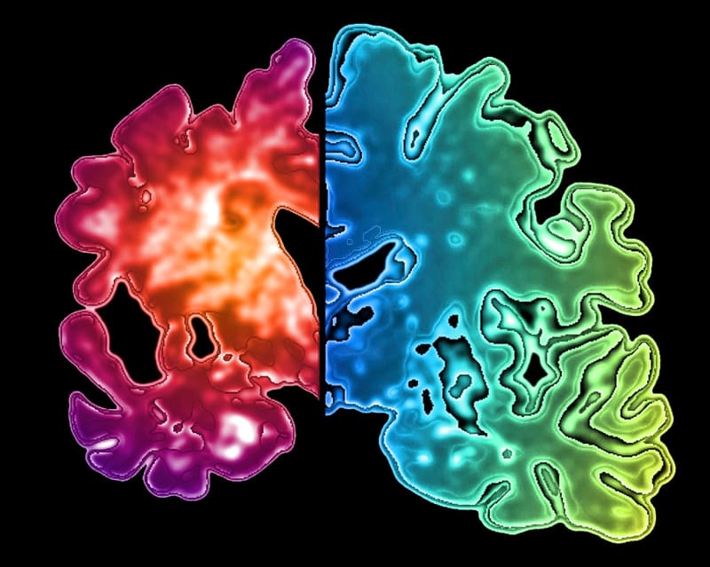 Mozek pacienta s Alzheimerovou chorobou