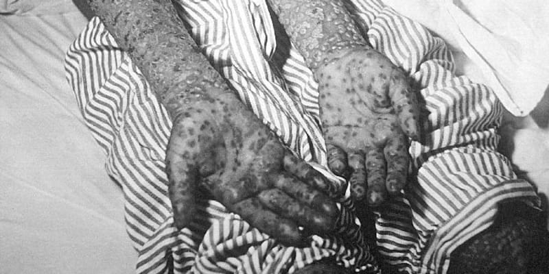 Pacient postižený neštovicemi v Jugoslávii na jaře 1972