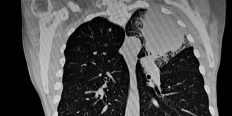 Nádor v plíci na rentgenu