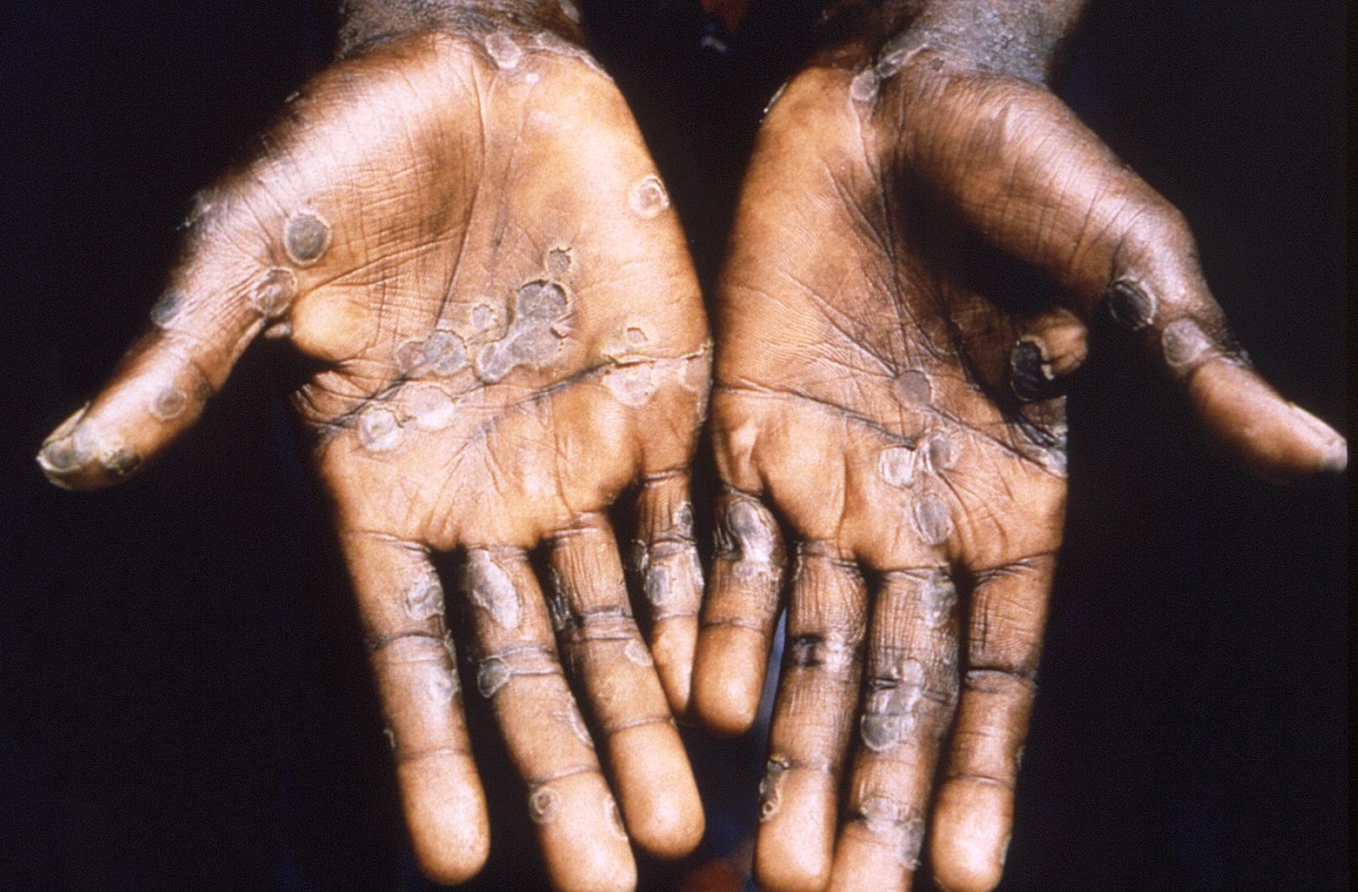 Následky opičích neštovic u pacienta z Demokratické republiky Kongo.