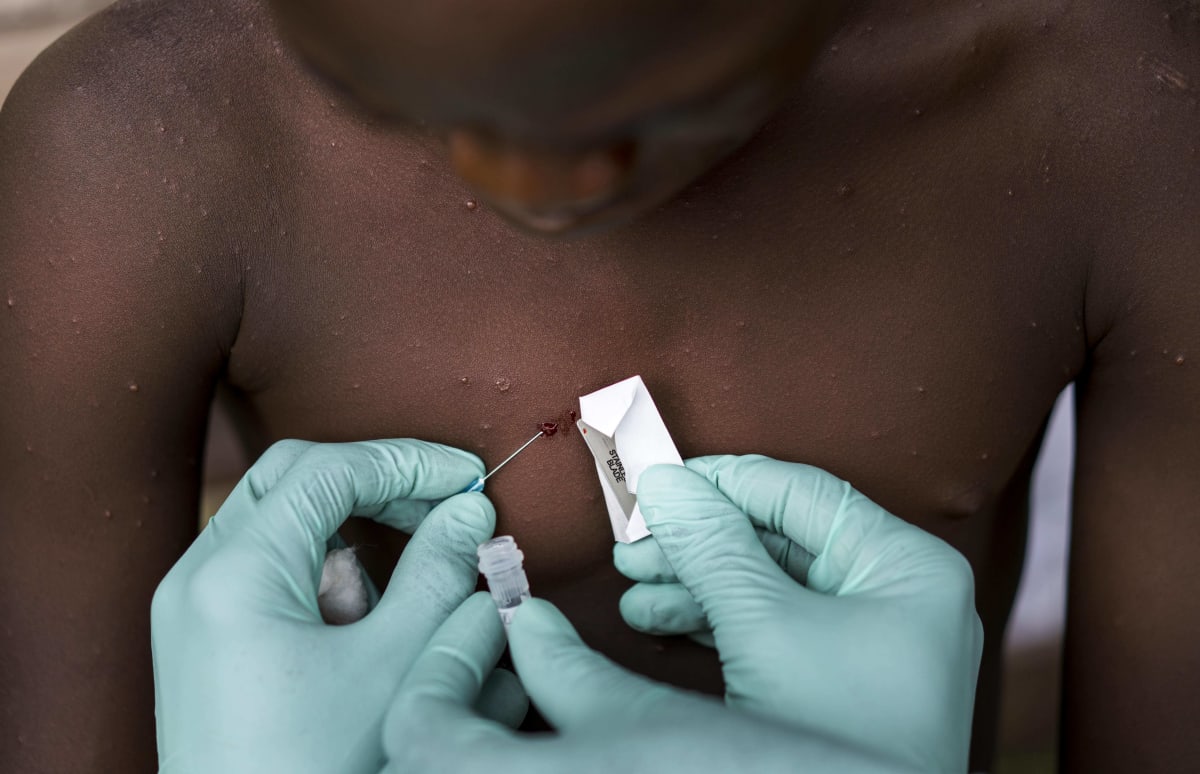 Lékaři v Demokratické republice Kongo provádí vyšetření na přítomnost opičích neštovic u jednoho z chlapců.