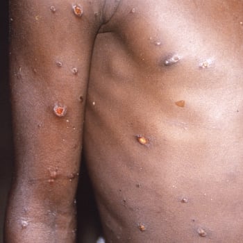 Nákaza se projevuje podobně jako lidské neštovice, byť s mírnějšími příznaky.