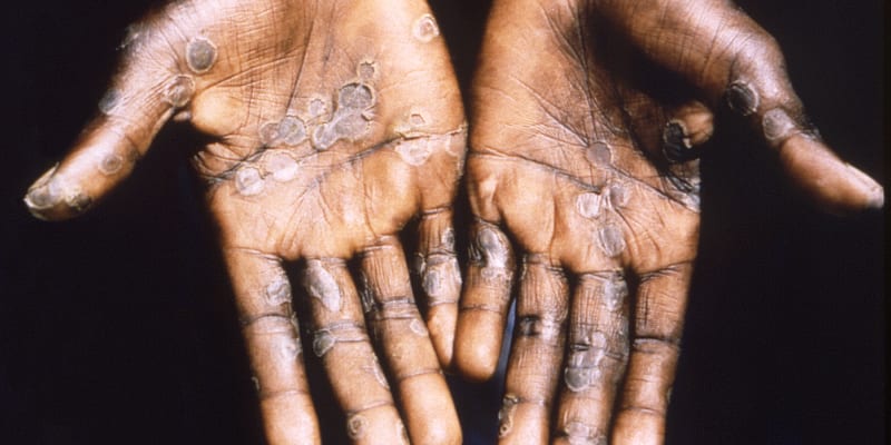 Následky opičích neštovic u pacienta z Demokratické republiky Kongo