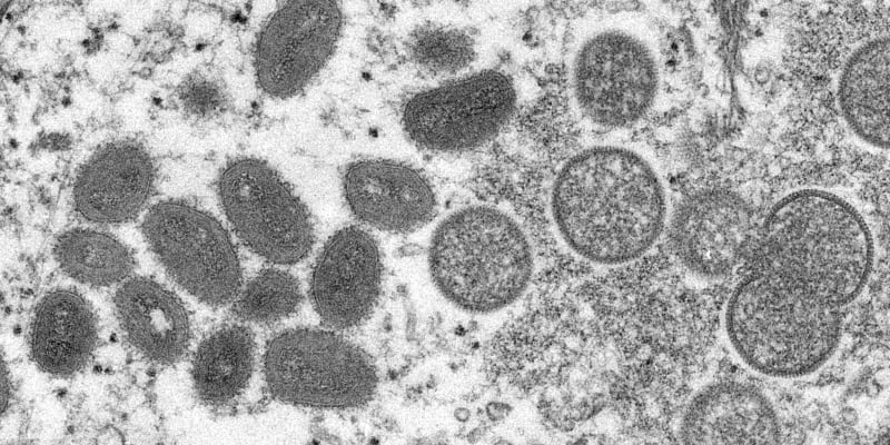 Viry opičích neštovic pod mikroskopem. Nemocí se může nakazit i člověk.