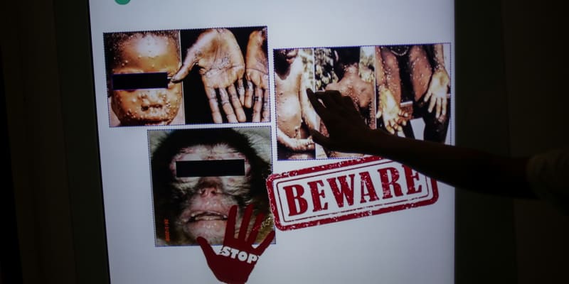 Květen 2022: V České republice se objevil první případ opičích neštovic.