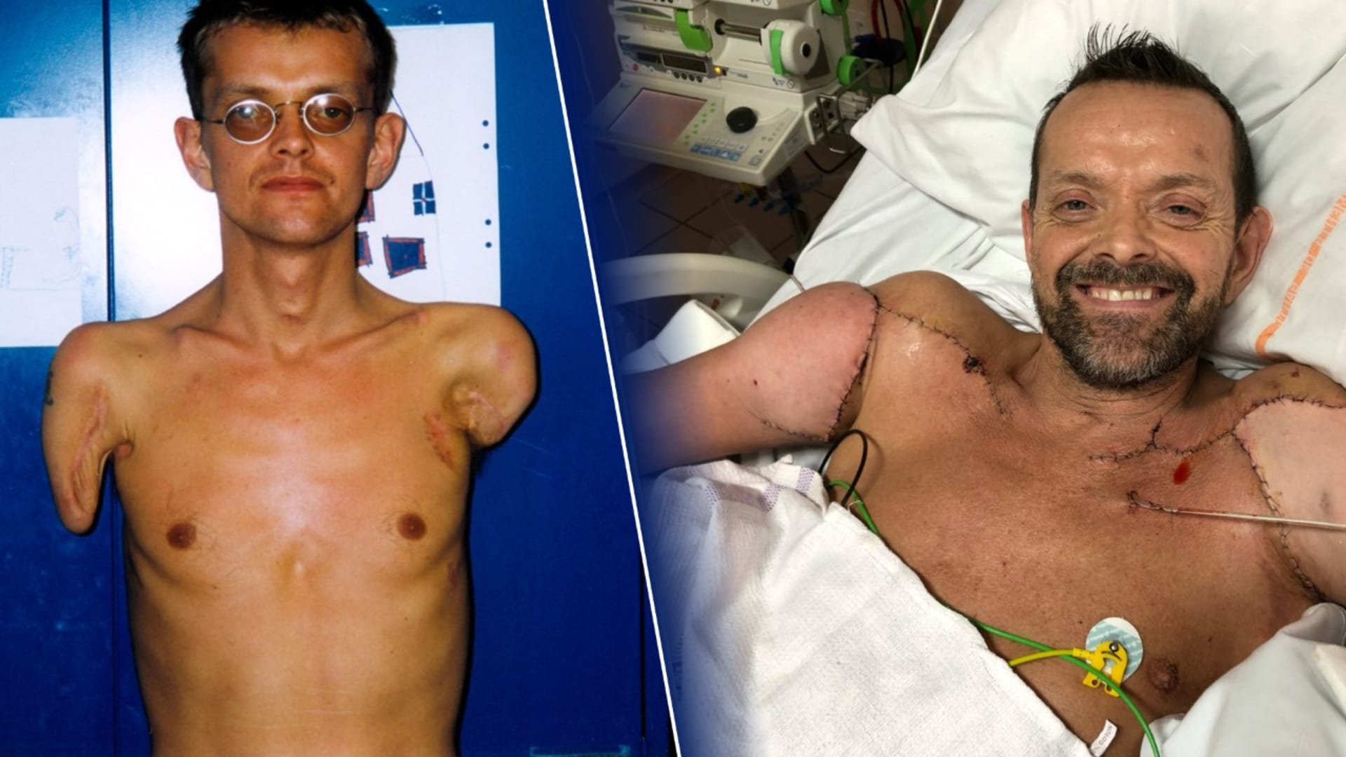 Jako první na světě podstoupil Felix Gretarsson transplantaci obou paží.
