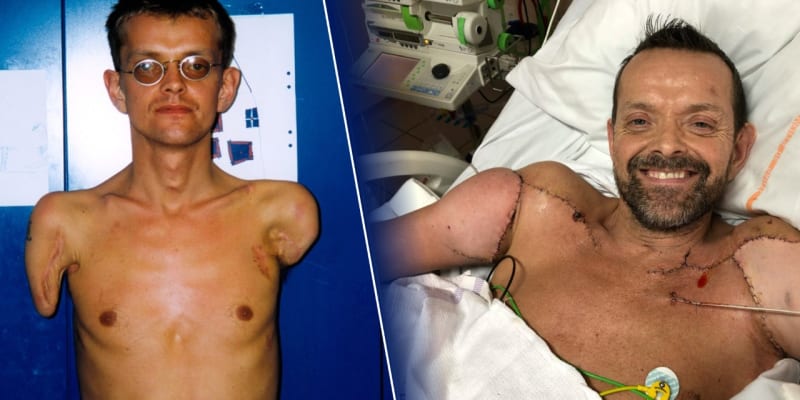 Jako první na světě podstoupil Felix Gretarsson transplantaci obou paží.